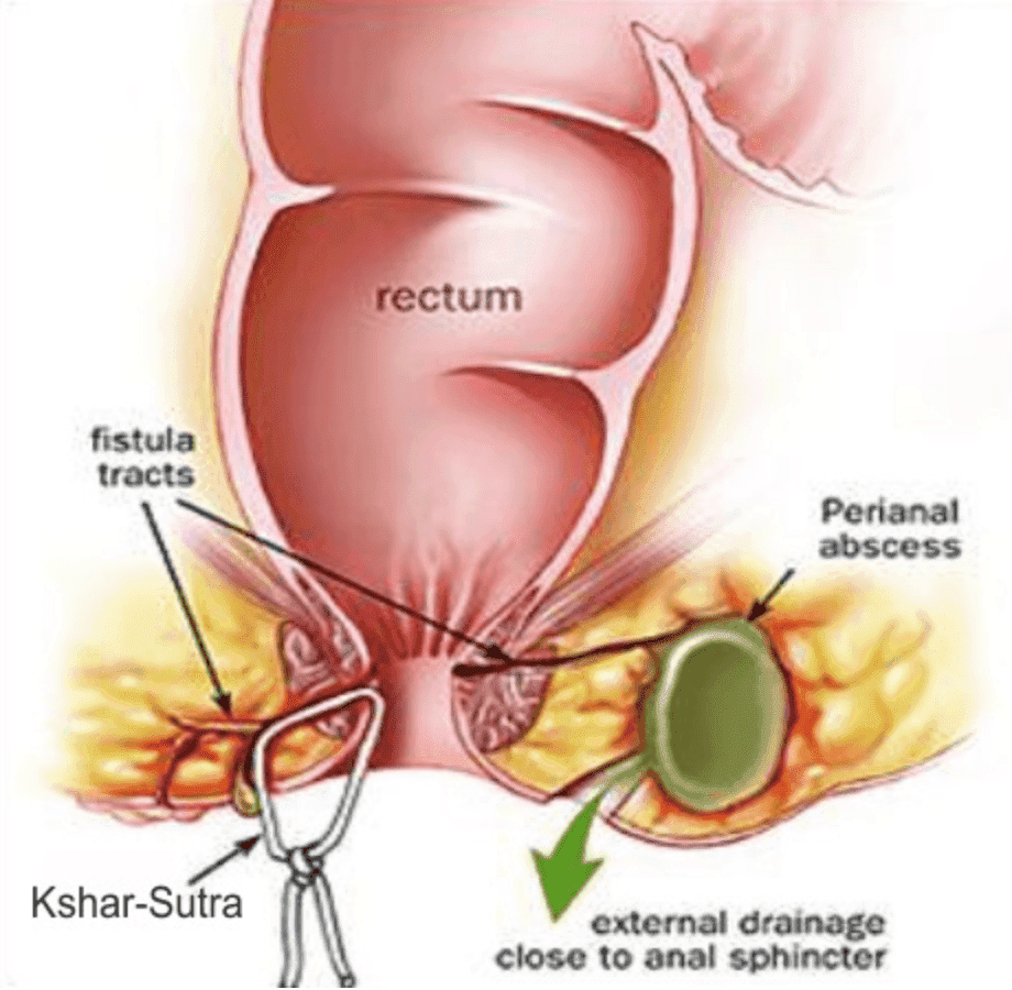 Fistula Ayurvedic Treatment